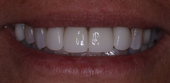 Implant Crown After