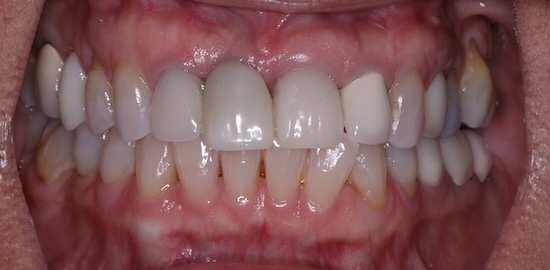 Implant Crown before