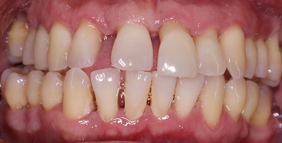 Implant crown before