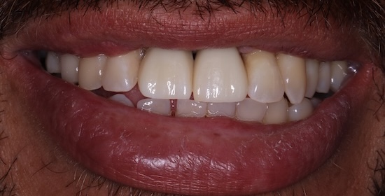 Implant crown After
