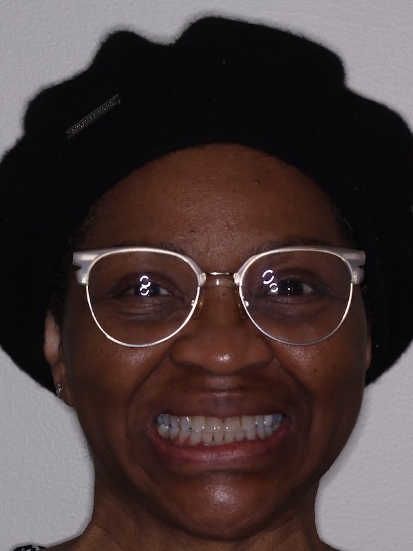 Clear Aligners full face after