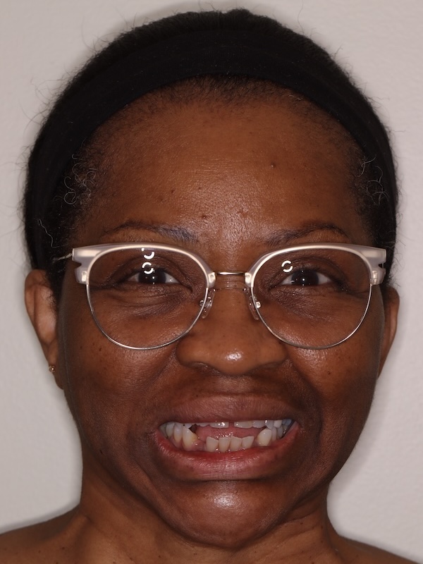 Clear Aligners full face before