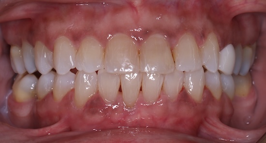 Clear Aligners after