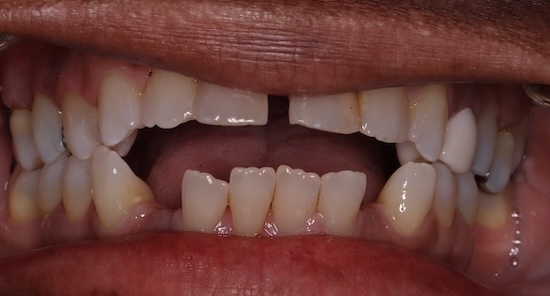 Clear Aligners before