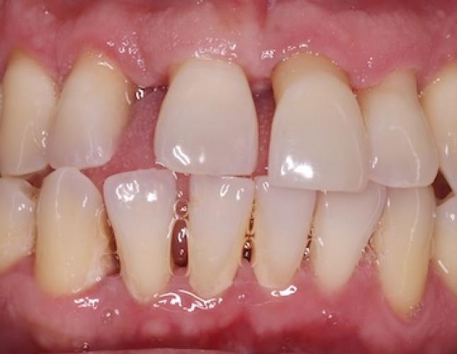 Implant crown before