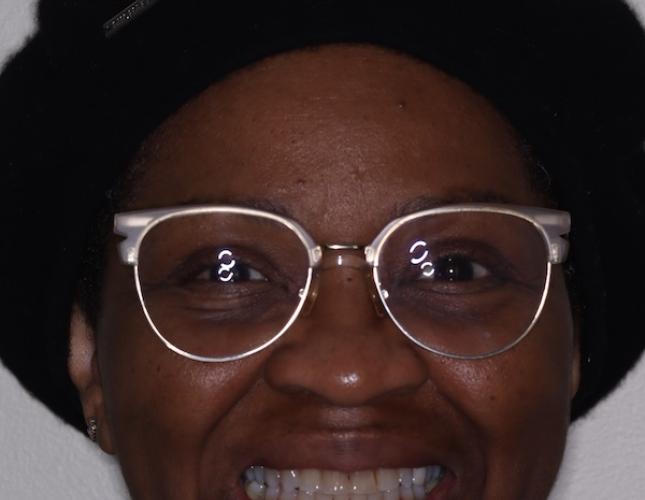 Clear Aligners full face after