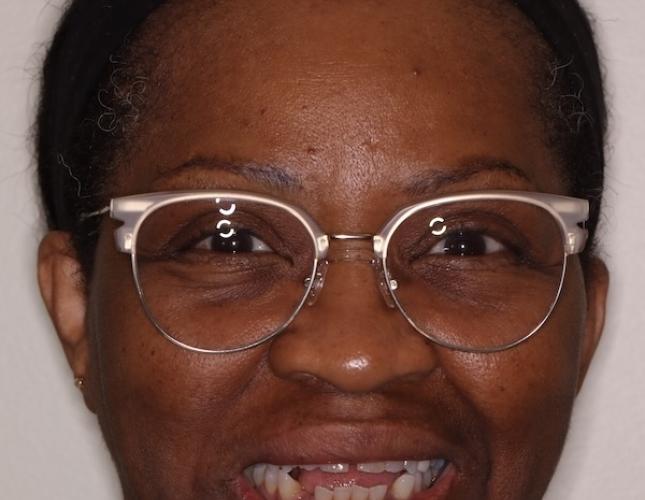 Clear Aligners full face before