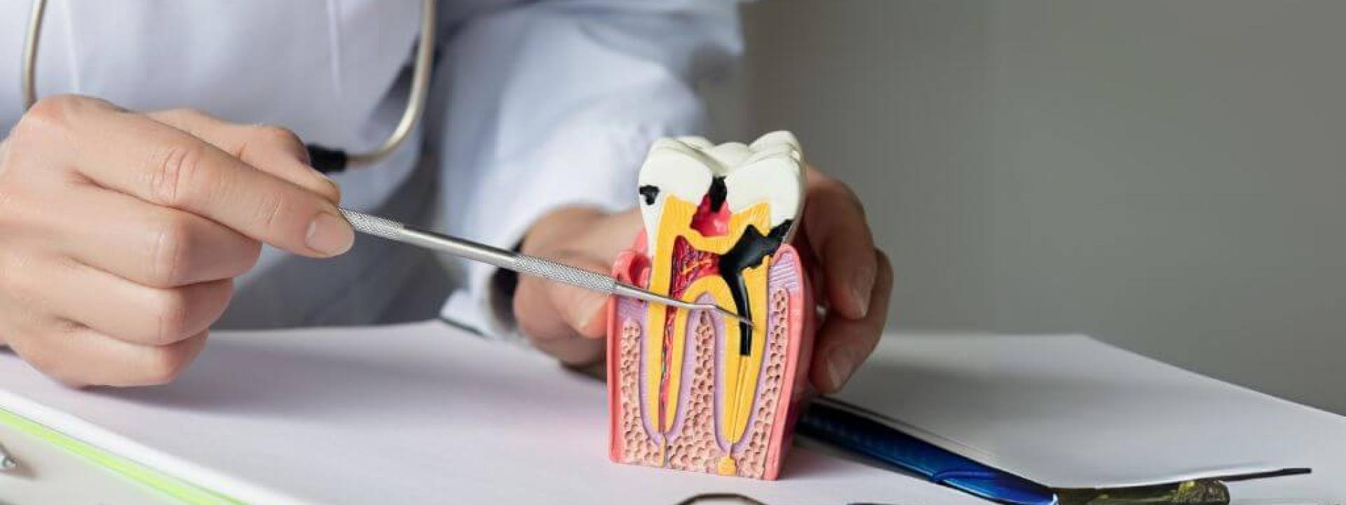 What to Expect During a Root Canal