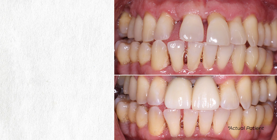 Invisalign to Straighten your Teeth